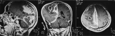 Dấu hiệu đau đầu do căn nguyên u não (Kỳ II) Hãy tìm hiểu thêm về nó